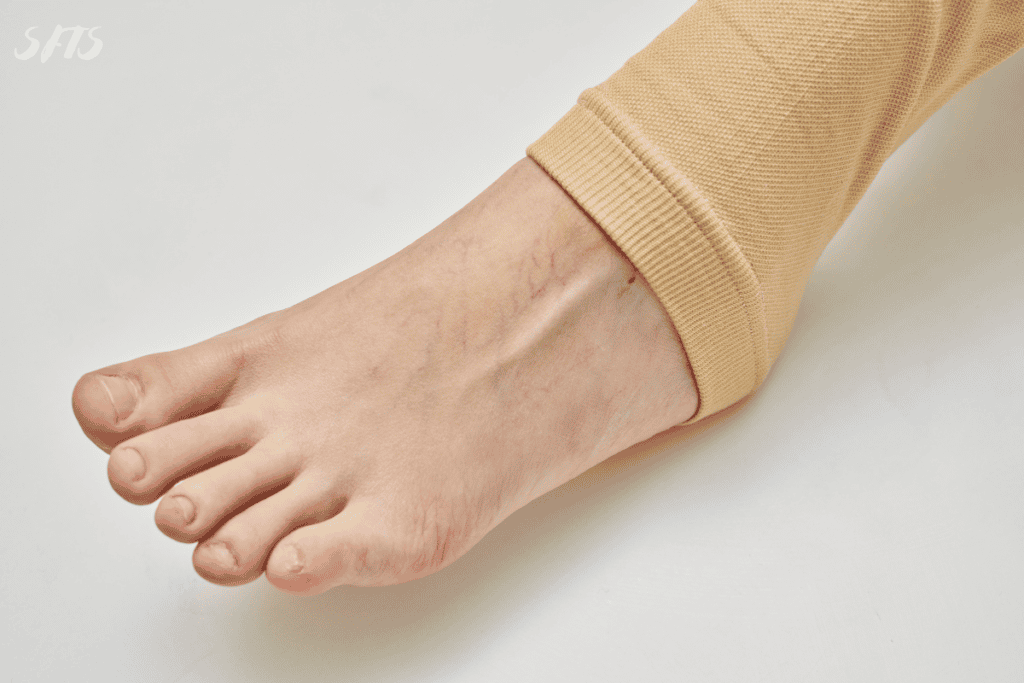 A closeup image of varicose veins on a foot.